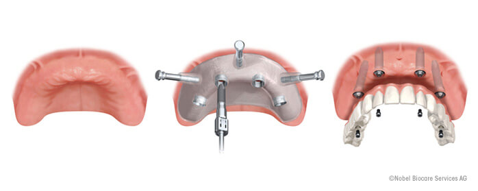 ODCのオールオン４