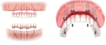 ODCのオールオン４