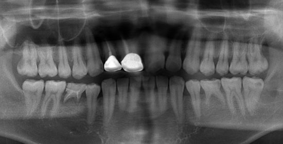 親知らず抜歯②