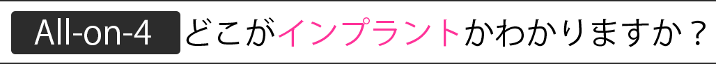 どこがインプラントかわかりますか？