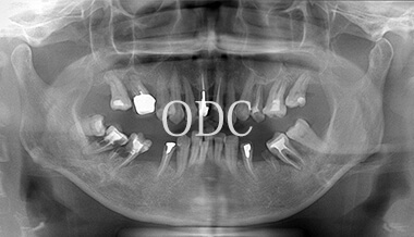 オールオンフォー症例4-1