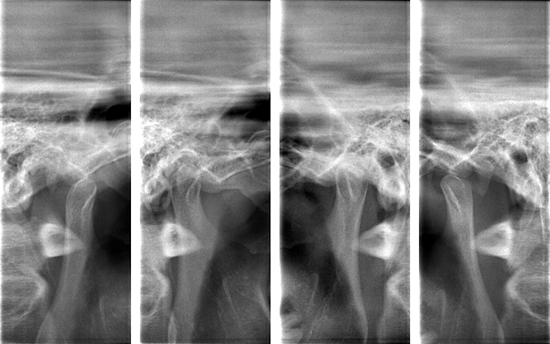顎関節症レントゲン
