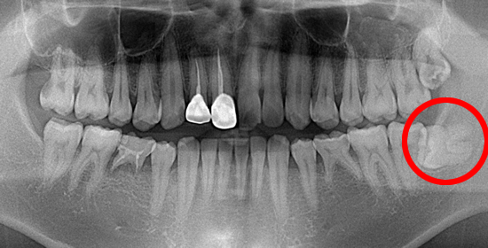親知らず抜歯①