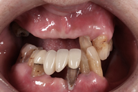 歯周病例2